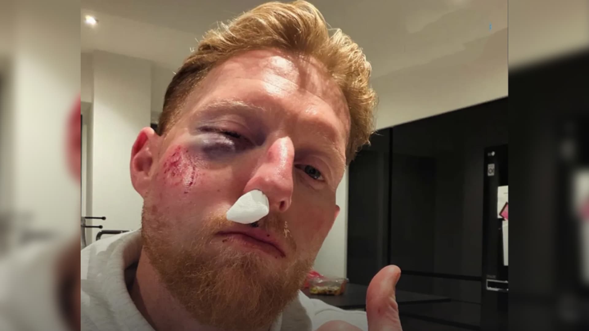 बलले लागेर बेन स्टोक्स घाइते